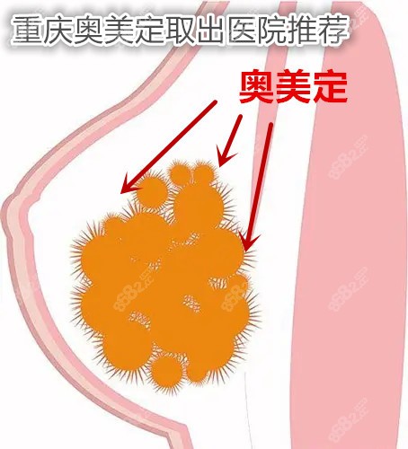 重庆奥美定取出医院推荐