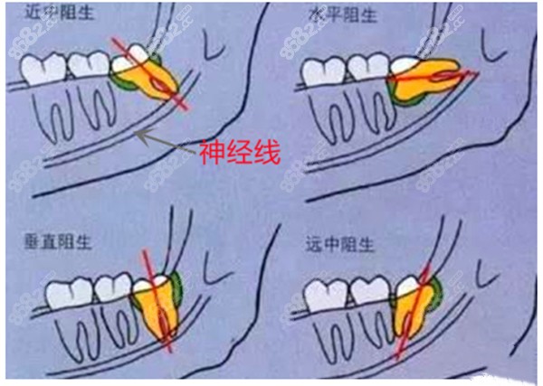 智齿的生长位置图