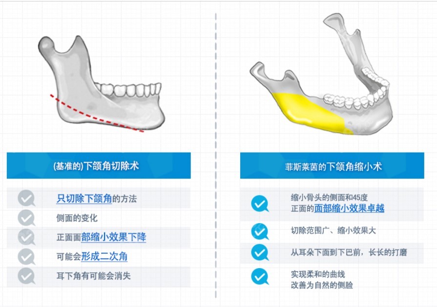 韩国菲斯莱茵下颌角缩小术和国内比区别