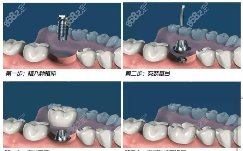 种植牙的步骤图示