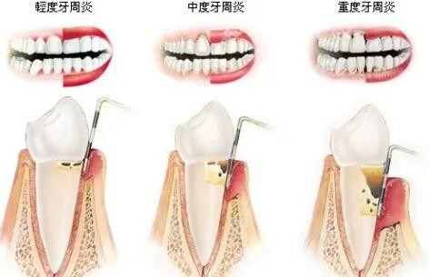 牙周炎是的程度分析