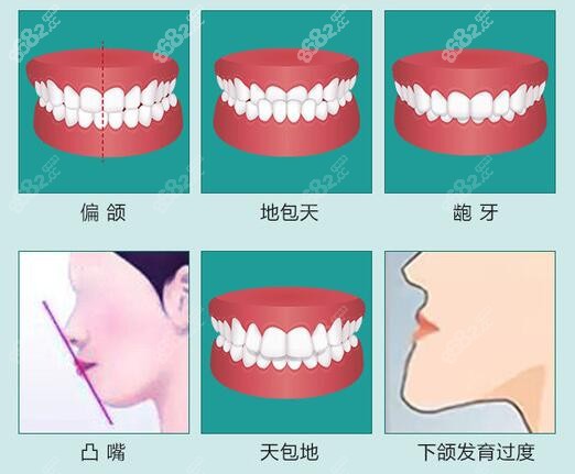 正颌手术可以改善的颌面问题