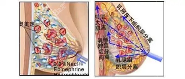 <!--<i data=20240705-sp></i>-->整形做乳房奥美定清除手术原理