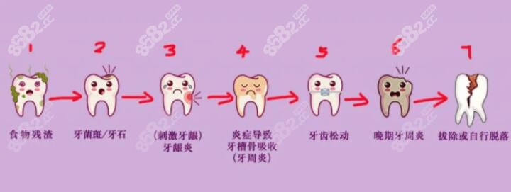 牙周炎的演變過程