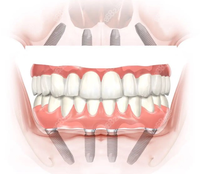 南通全口种植牙多少钱 南通全口种植牙多少钱