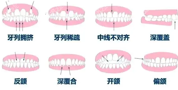 牙齿畸形