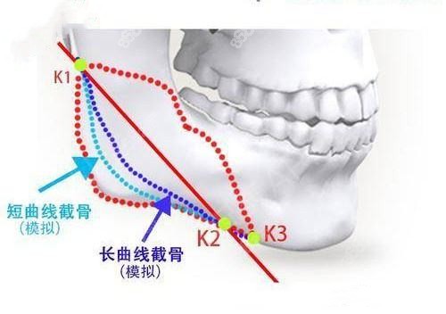 www.8682.cc提供的武汉改脸型技术图解