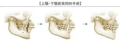 <!--<i data=20240705-sp></i>-->做正颌手术好吗