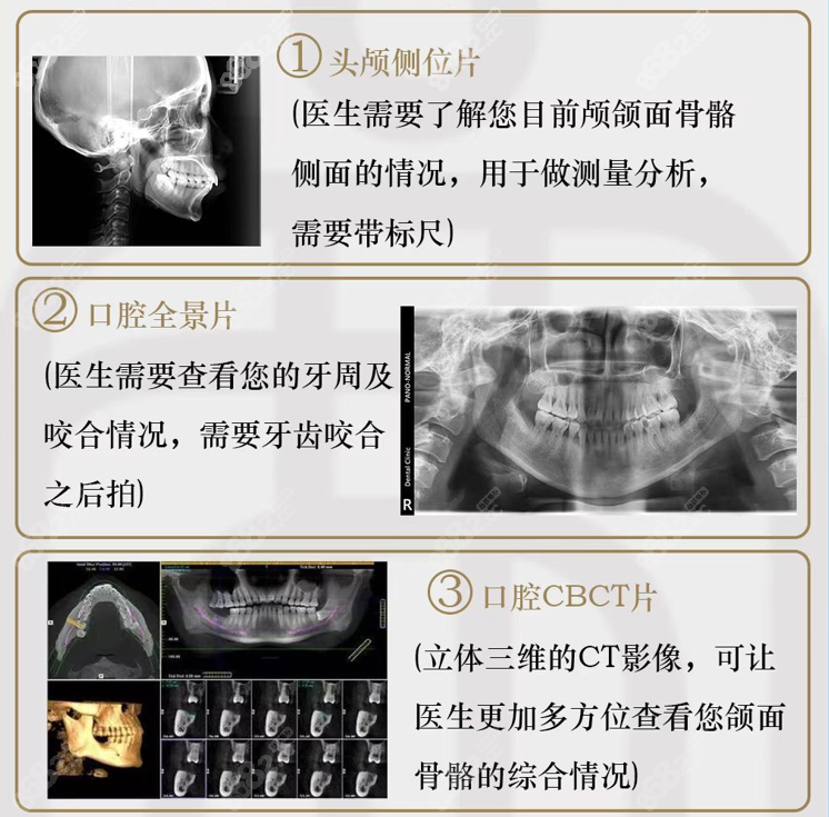 重庆北部宽仁医院做正颌价格