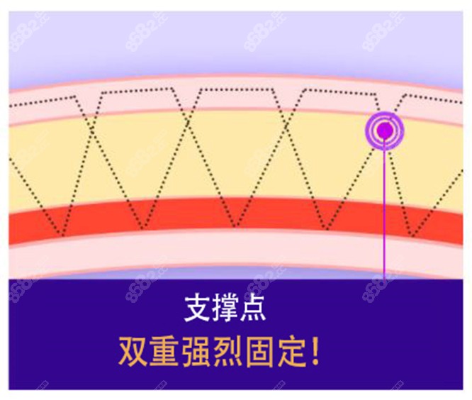 韩国TS整形外科的双眼皮技术