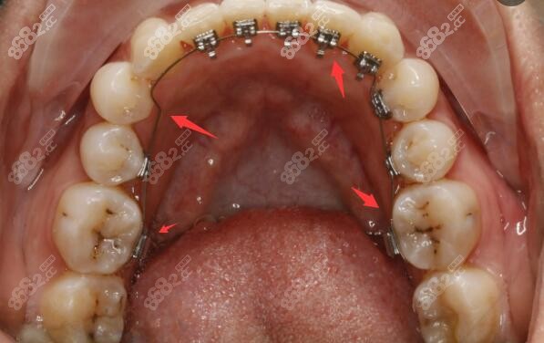舌侧正畸的正畸展示