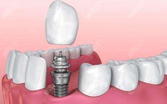 种植牙治疗过程展示 种植牙治疗过程展示