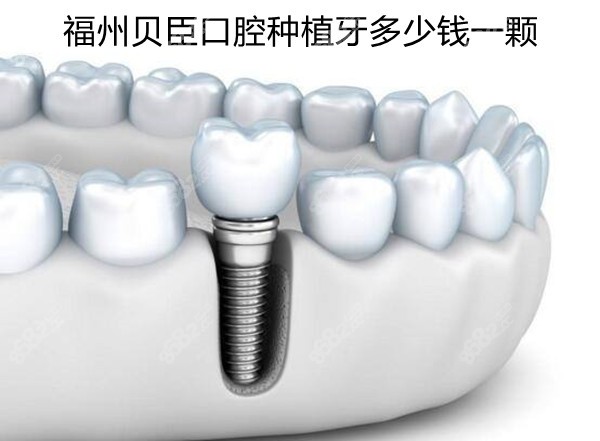 福州貝臣齒科種植牙價格