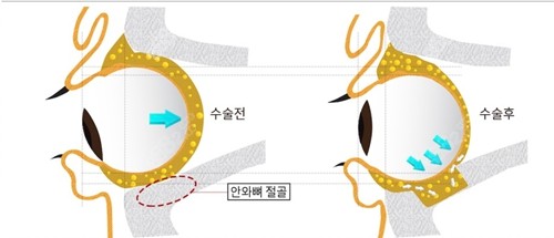 必当归医院突眼矫正技术优势