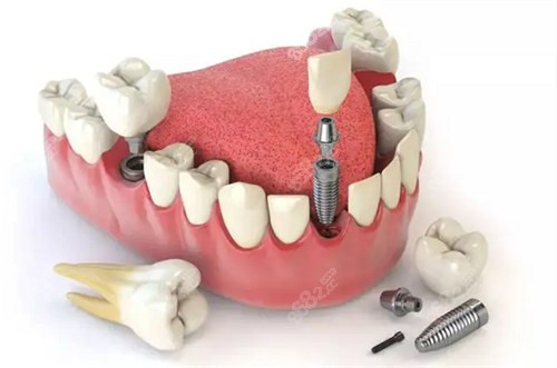 嘉兴种植牙水平倒是不错 嘉兴种植牙水平倒是不错