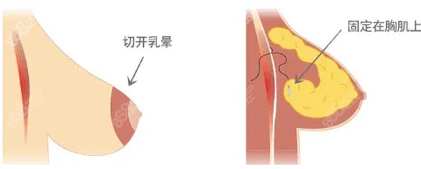 陶宏伟医生做乳房下垂矫正的原理图
