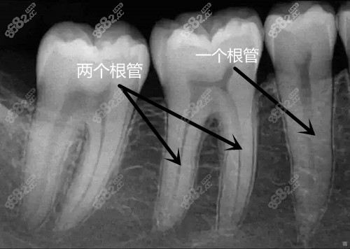 几种因素:根管治疗的价格区间浮动还是比较大的,前牙和磨牙的价格浮动
