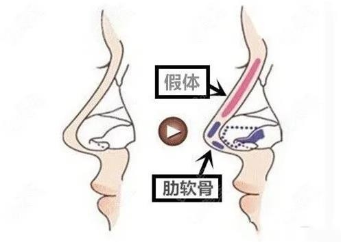 肋软骨隆鼻技术示意图