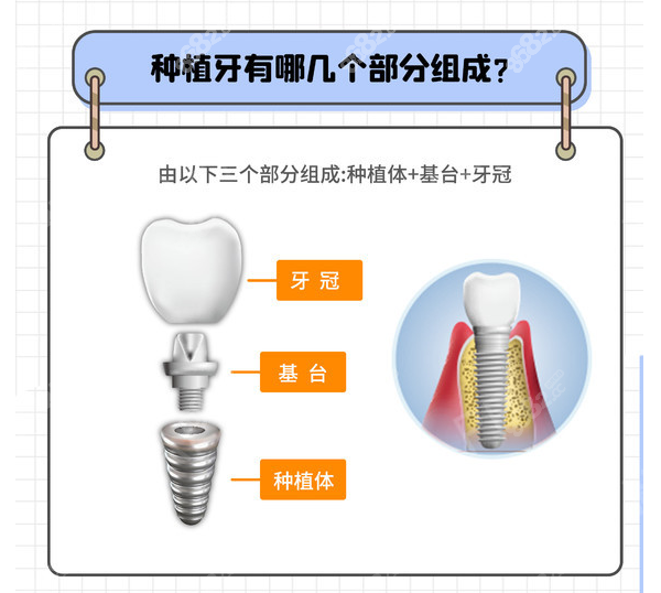 德国种植体品牌大全及价格