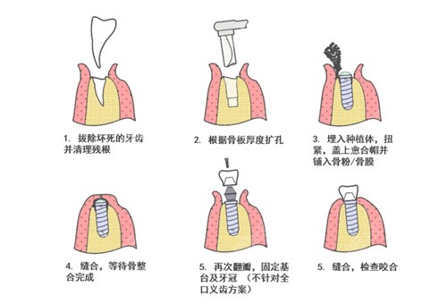 嘉兴种植牙技术好的很 嘉兴种植牙技术好的很