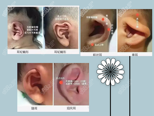 新生儿耳朵畸形分为哪些种类？
