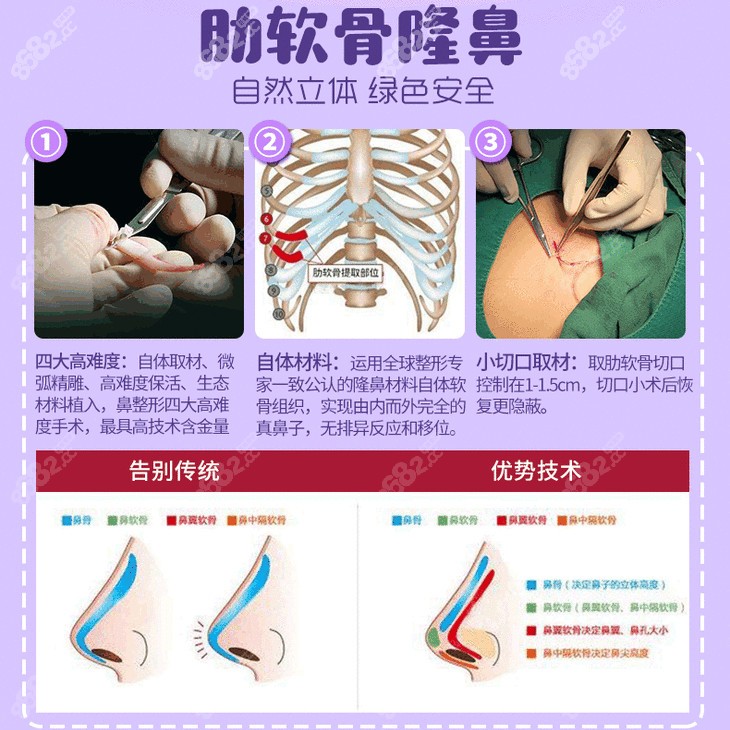 <!--<i data=20240705-sp></i>-->医生做肋骨鼻综合手术原理