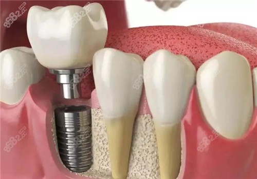 嘉兴种植牙技术真的蛮好的 嘉兴种植牙技术真的蛮好的