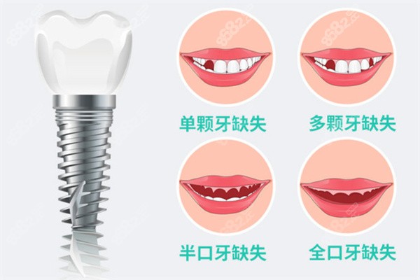 种植牙适应症了解一下