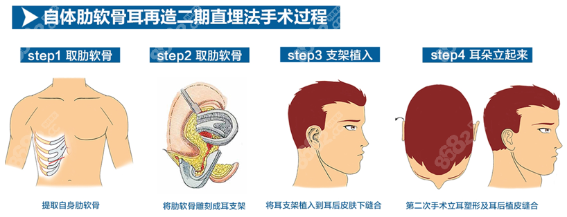 重庆北部宽仁医院耳再造价格贵不