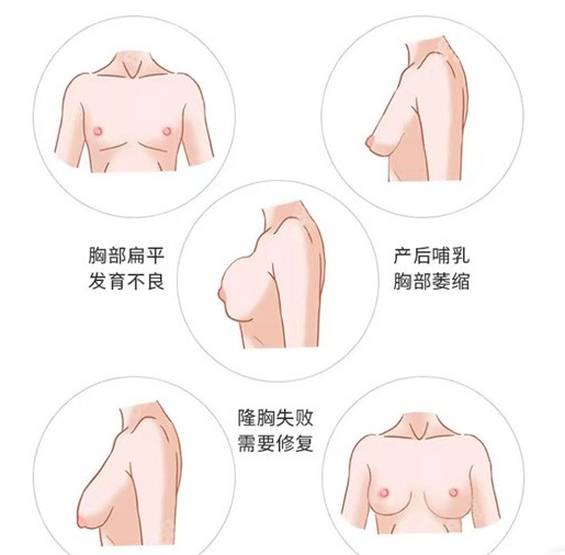 温州假体隆胸哪里好