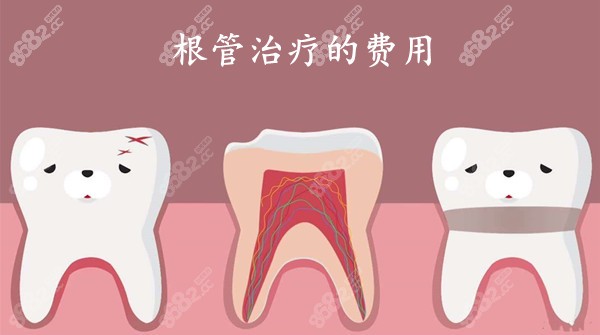 牙齿根管治疗费用多少钱一颗