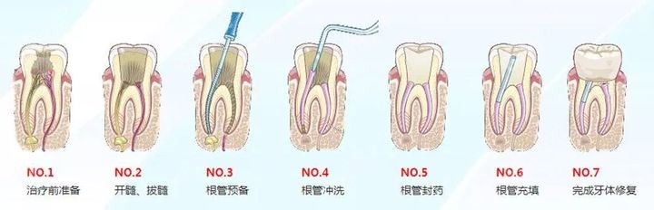 根管治疗的过程及步骤