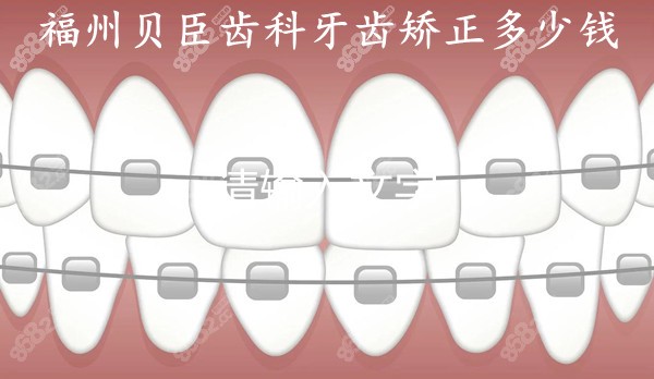 福州贝臣牙齿矫正多少钱