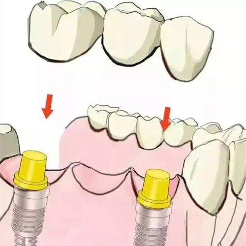 晋城做同一部位连续种三颗牙的手术原理