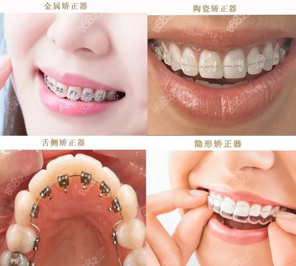重庆市矫正牙齿大概在什么价位