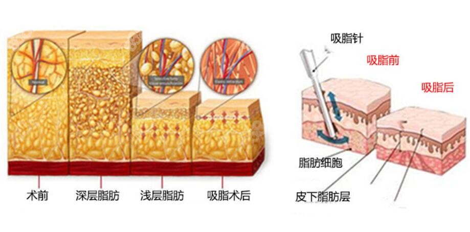 土麦森吸脂技术图示