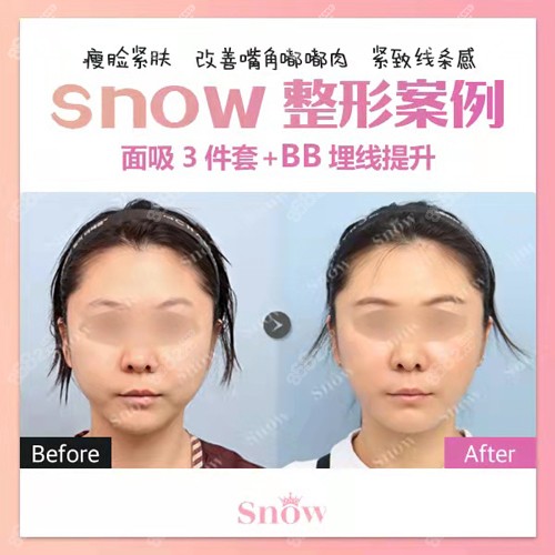 在韩国snow整形做面吸后嘴角嘟嘟肉消失