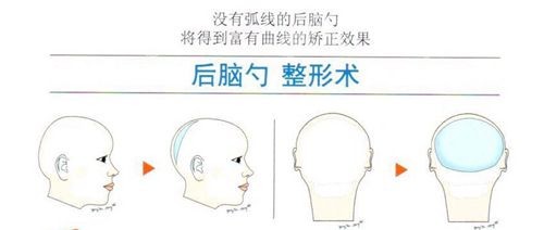 后脑勺整形