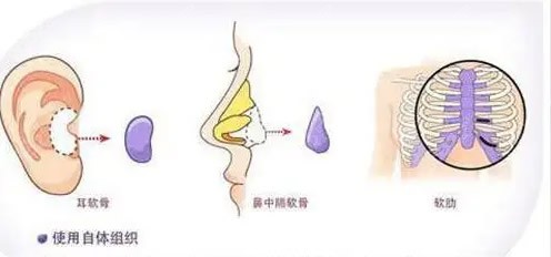 合肥自体软骨隆鼻价格