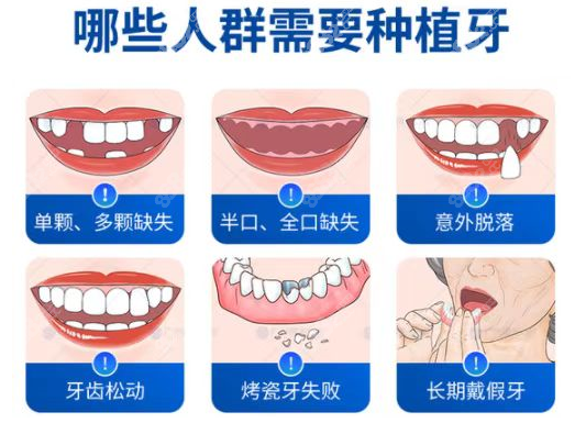 南宁岭南口腔常做的种植牙类型