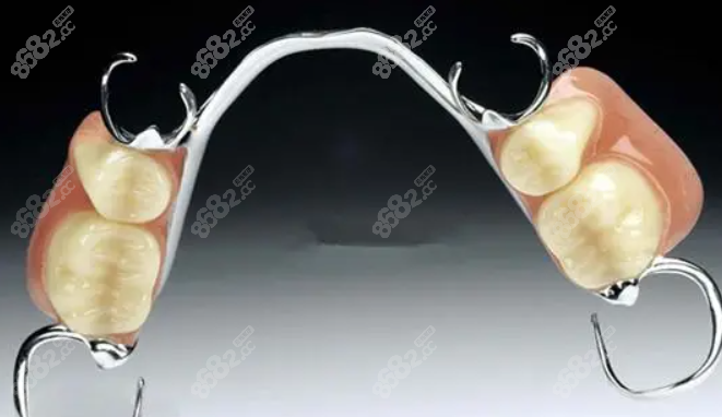 传统支架假牙