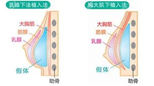 上海伯思立整形医院丰胸技术