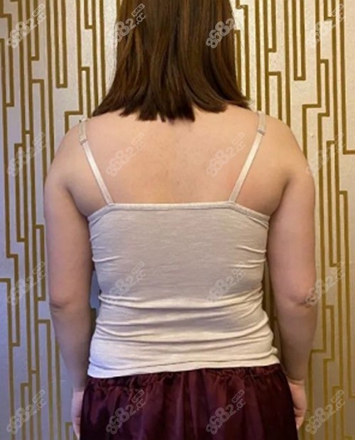 肩背部抽脂案例图片图片