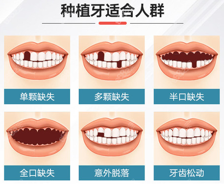 桂林源树口腔做种植牙的类型