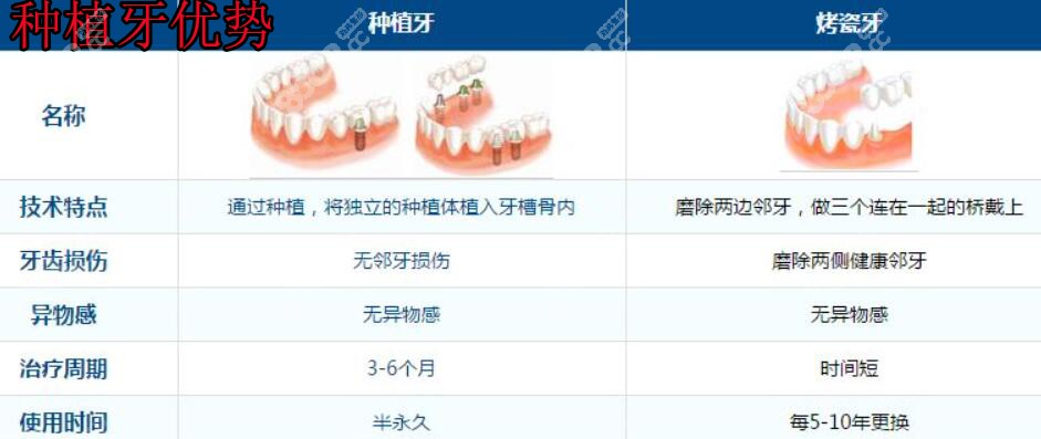 种植牙优势 种植牙优势