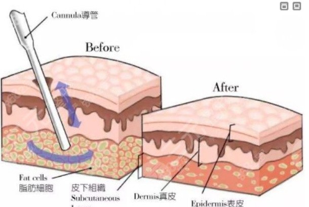 南京陈孝闯吸脂怎么样