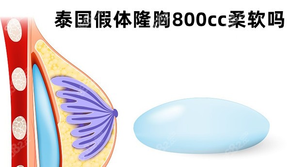 泰国假体隆胸800cc柔软吗