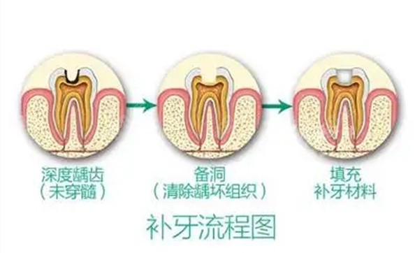 山西省补牙手术各城市价格不同