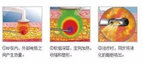 南京艺星李法庆医生5G天使光雕吸脂技术优势解析