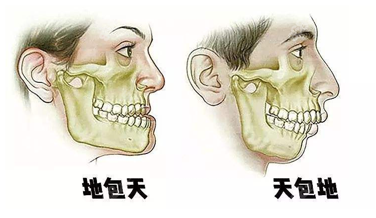 正颌手术类型